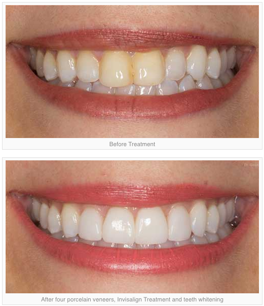 Dental Veneers