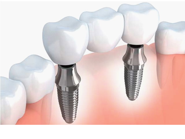 Dental Implants