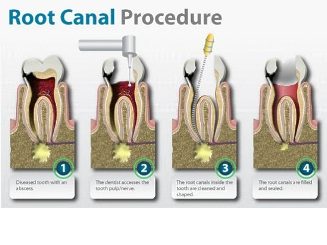 Root Canal